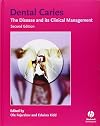 Dental Caries: The Disease and Its Clinical Management