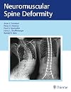 Neuromuscular Spine Deformity