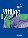 Vitiligo
